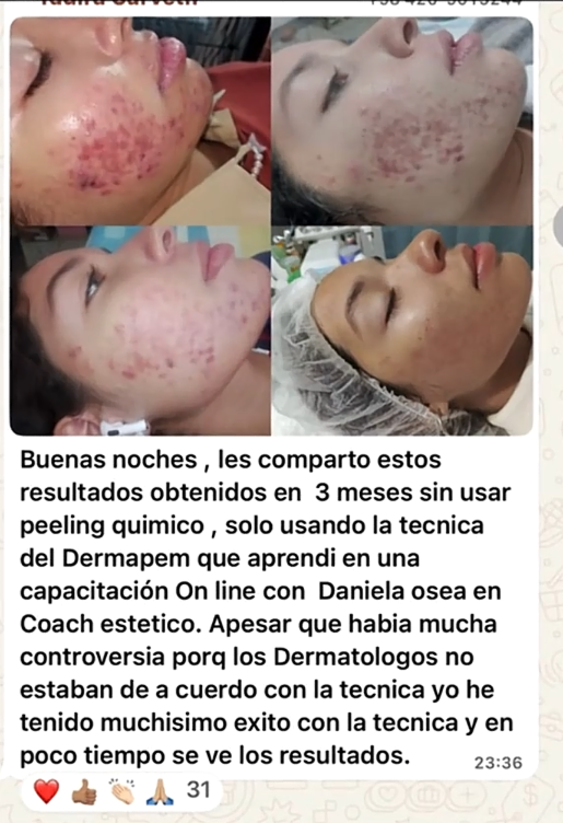 Testimonio de alumna con resultados de acné tras aplicar la técnica