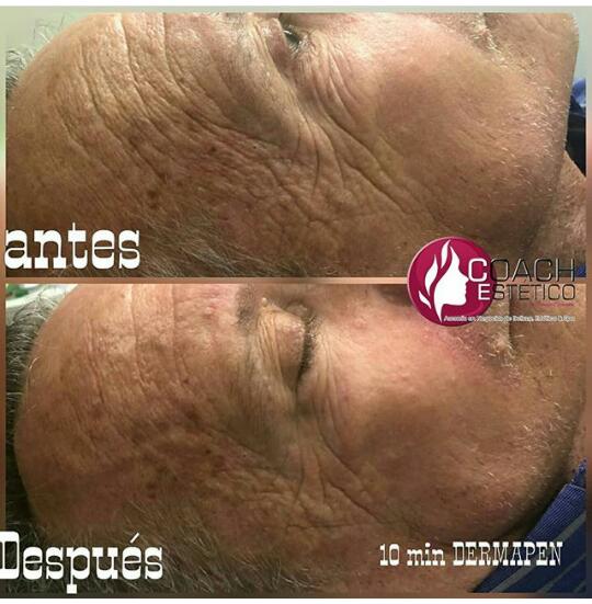Antes y después — Elastosis