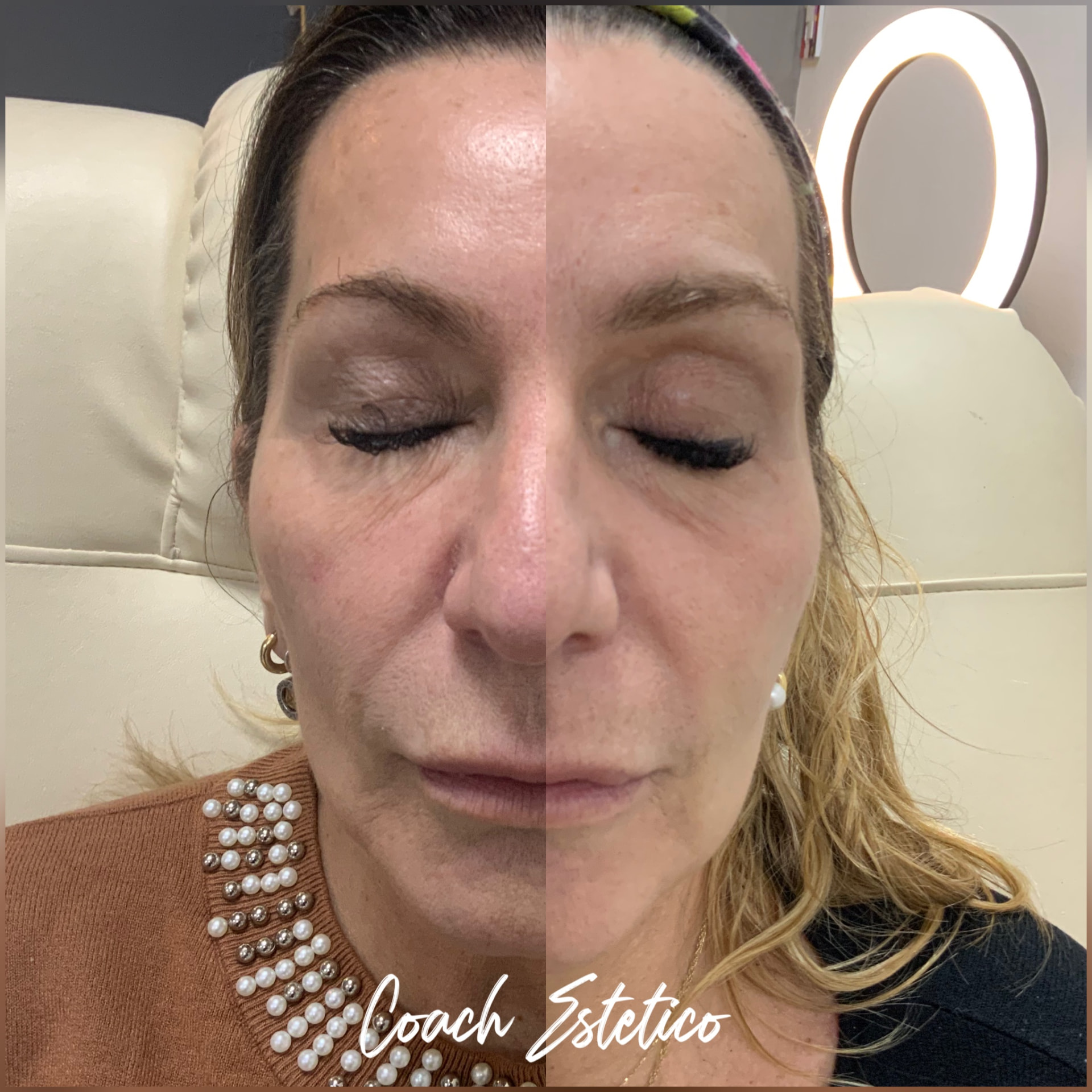 Antes y después — Contorno de ojos