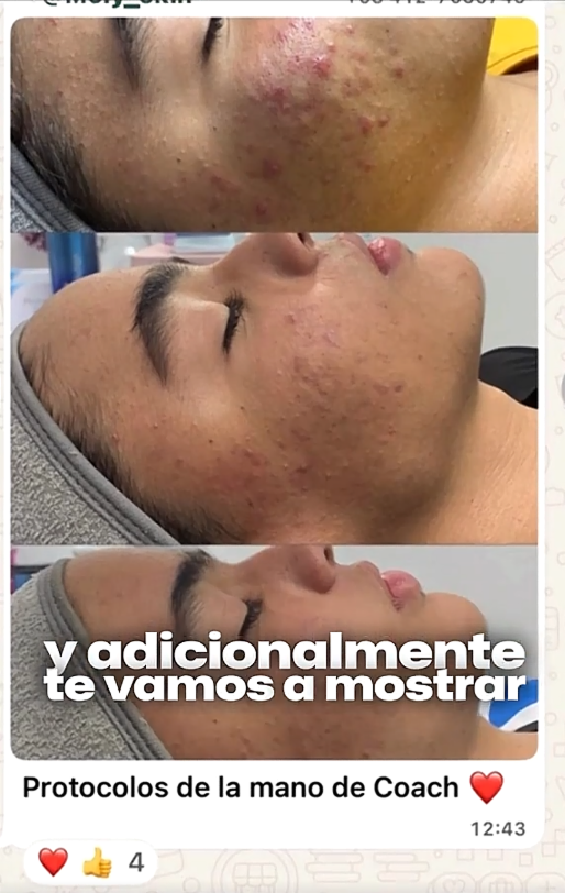 Testimonio con protocolos aplicados en piel con acné