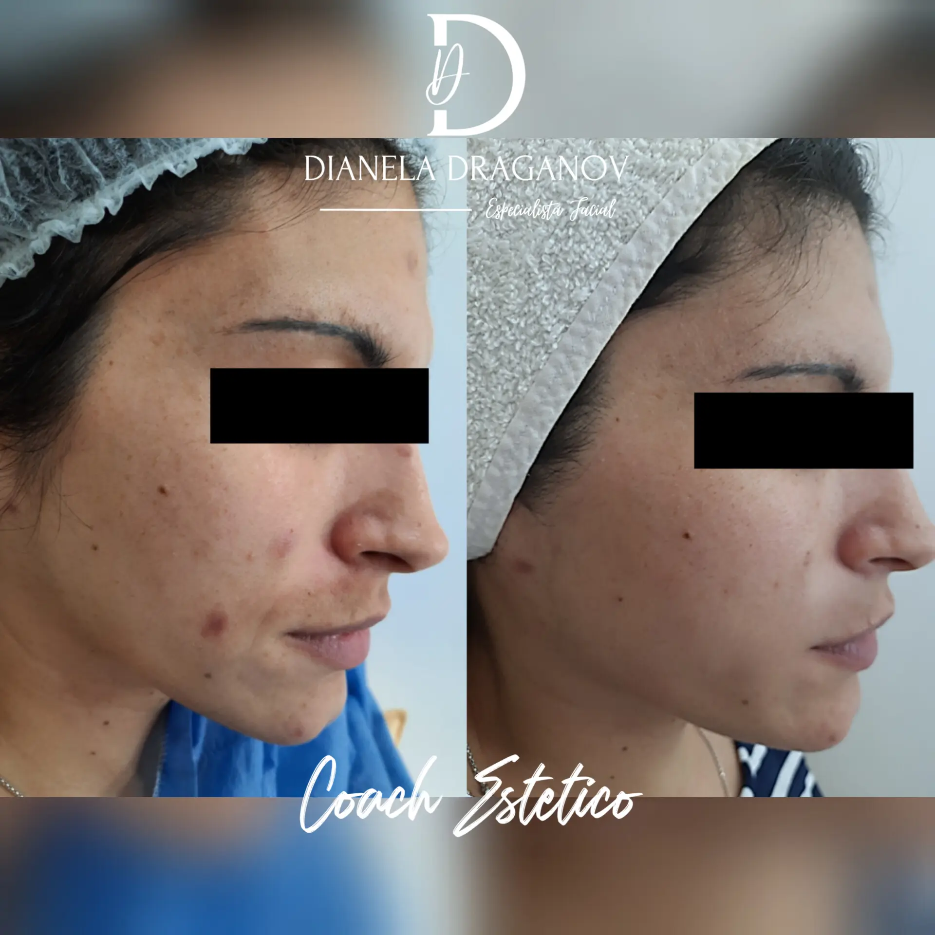 Antes y después — Piel acneica